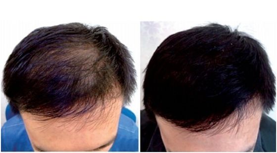 Red Light Laser Diode Helmet For Hair Growth 1360mW