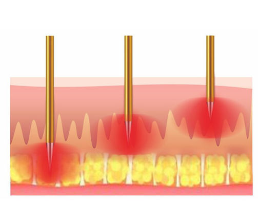Fractional Rf Radio Frequency Skin Tightening Microneedle Machine For Beauty Center