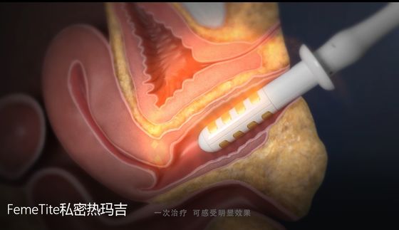 Non Surgical Therapy Vaginal Rejuvenation Radio Frequency For Clinical