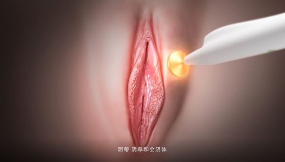 Female RF Vaginal Rejuvenation Thermage Vulva Rejuvenation Laser Urinary Incontinence